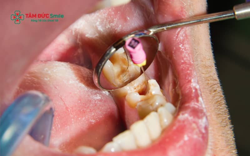 Khi răng đau kéo dài, đổi màu, có mủ hoặc hôi miệng, người bệnh cần Abc8b tỷ lệ kèo World Cup 2026 tủy răng tại LINK TRANG CHỦ ABC88 CHUẨN 2026 để loại bỏ triệt để ổ viêm và bảo tồn răng