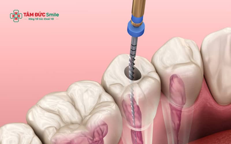 Nhiều cách làm chết tủy răng tại nhà như dùng thuốc không kiểm soát hoặc mẹo dân gian chỉ giúp giảm đau tạm thời và có thể gây biến chứng nguy hiểm
