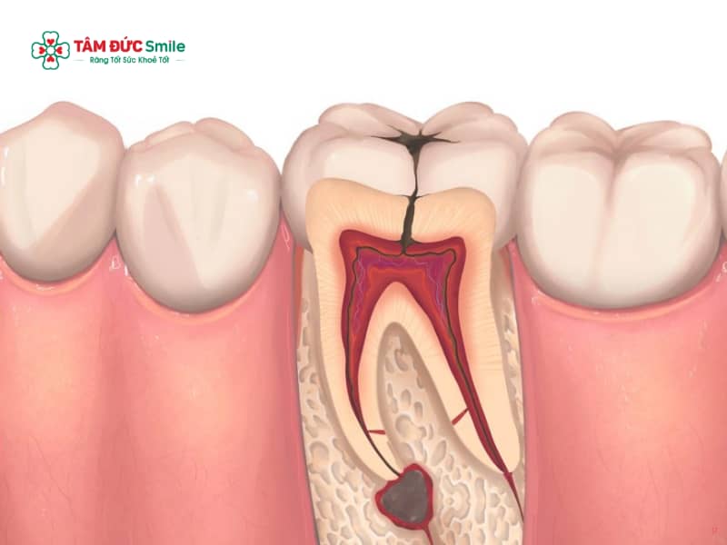 Cách làm chết tủy răng tại nhà: Dấu hiệu viêm tủy và nguy hiểm tiềm ẩn