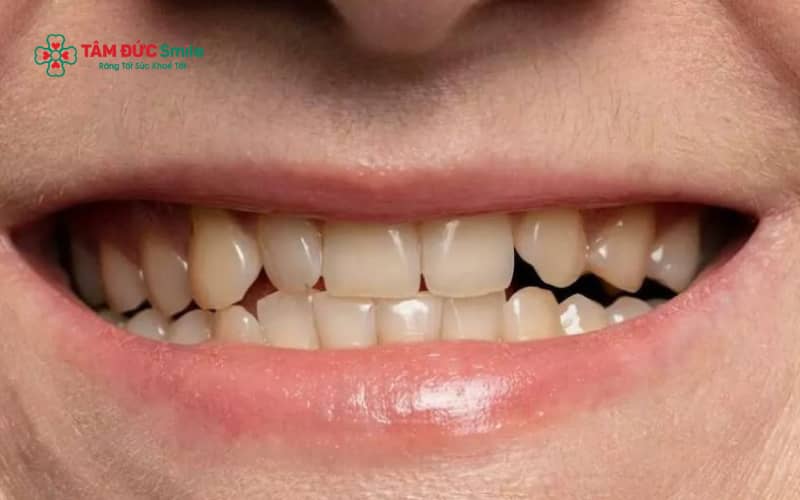 Thực phẩm sậm màu, thói quen sinh hoạt không lành mạnh, vệ sinh ABC8 là nhà cái cá cược trực tuyến uy tín số 1 tại Việt Nam sai cách và nhiễm màu do thuốc là những nguyên nhân phổ biến gây răng ố vàng lâu năm