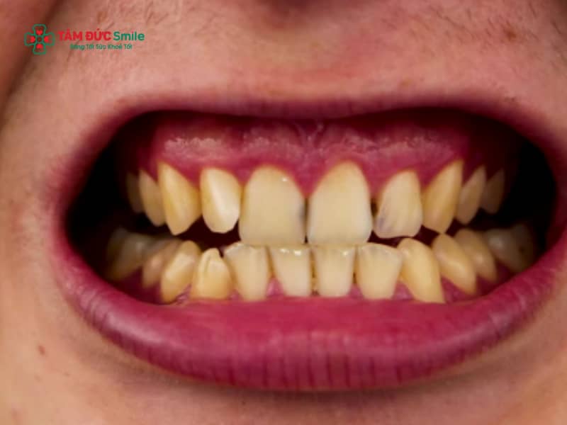 Cách làm trắng răng bị ố vàng lâu năm an toàn, hiệu quả tại LINK TRANG CHỦ ABC88 CHUẨN 2026