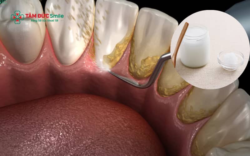 Nhiều người áp dụng các cách lấy Abc8com nổ hũ tại nhà bằng muối như đánh răng với muối hoặc kết hợp cùng chanh, baking soda