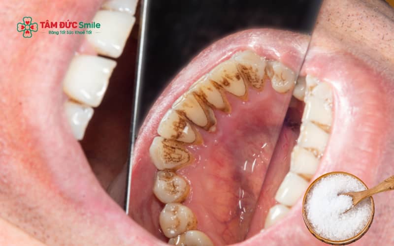 Muối chỉ giúp làm sạch mảng bám nhẹ trên bề mặt răng, không thể loại bỏ Abc8com nổ hũ đã vôi hóa lâu ngày