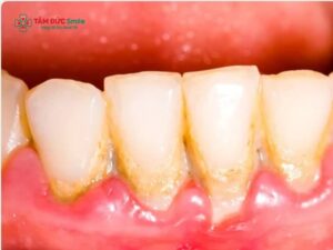 Cách lấy Abc8com nổ hũ tại nhà bằng muối: Có hiệu quả không và lưu ý an toàn