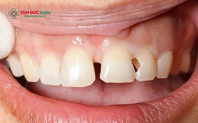 Răng bị mẻ không được phục hồi kịp thời có thể gây ê buốt, tăng nguy cơ ABC88 com đăng nhập, viêm tủy và ảnh hưởng nghiêm trọng đến chức năng ăn nhai