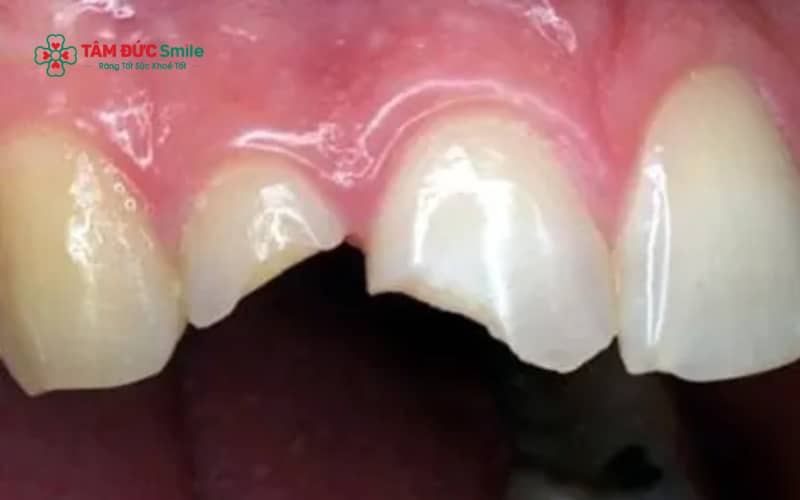 Xử lý răng bị mẻ tại nhà đúng cách ngay khi mới xảy ra giúp giảm đau, hạn chế vi khuẩn xâm nhập và bảo vệ mô răng tạm thời.