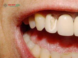 Cách phục hồi răng bị mẻ tại nhà​ và lưu ý