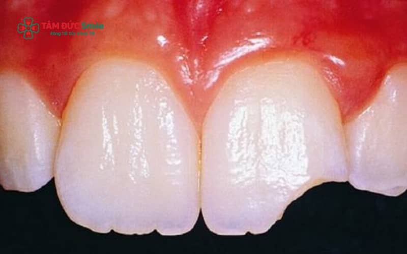 Cắn vật cứng, va đập mạnh, nghiến răng kéo dài hoặc men răng suy yếu do ABC88 com đăng nhập là những nguyên nhân phổ biến gây mẻ răng.