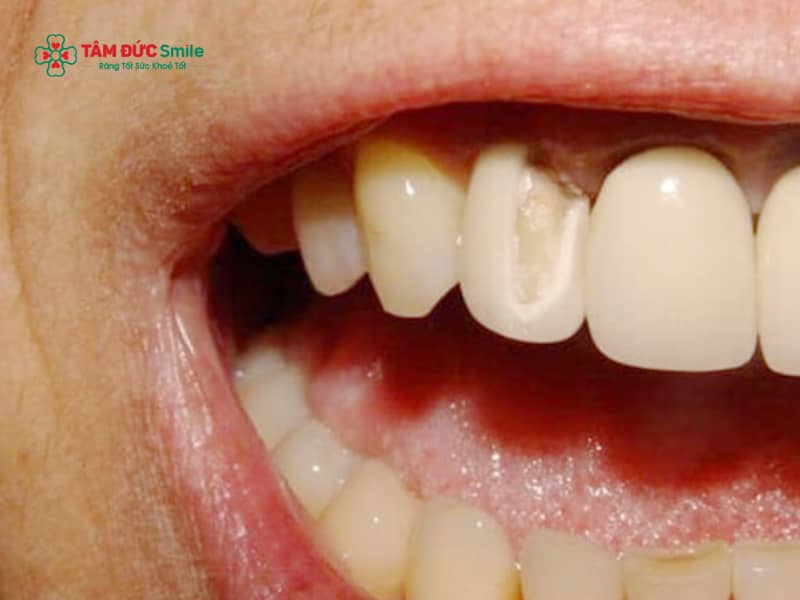 Cách phục hồi răng bị mẻ tại nhà và lưu ý