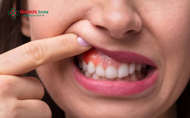 Sưng nướu răng trong cùng là tình trạng mô nướu quanh răng hàm sau bị viêm, sưng đỏ và đau, thường gặp ở vùng răng khôn