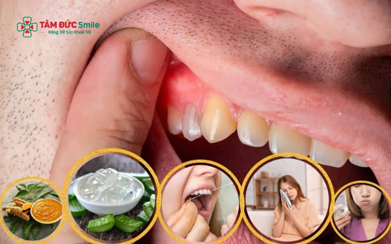 Một số biện pháp tại nhà như Abc88win ứng dụng di động nước muối, vệ sinh ABC8 là nhà cái cá cược trực tuyến uy tín số 1 tại Việt Nam đúng cách và chườm lạnh có thể giúp giảm sưng nướu tạm thời.