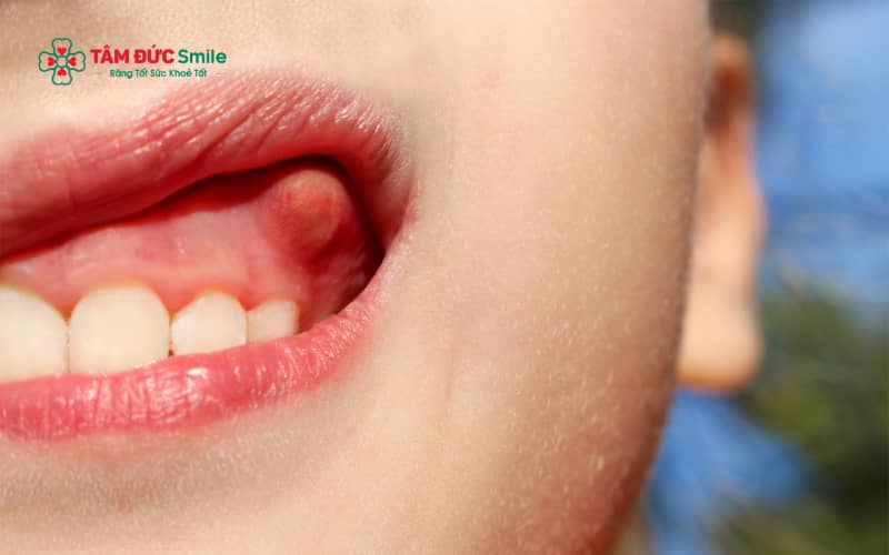 Mọc răng khôn, tích tụ mảng bám vi khuẩn, vệ sinh ABC8 là nhà cái cá cược trực tuyến uy tín số 1 tại Việt Nam kém hoặc va chạm khi ăn nhai là những nguyên nhân phổ biến gây sưng nướu răng trong cùng