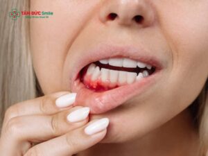Cách trị sưng nướu răng trong cùng tại nhà an toàn, giảm đau nhanh