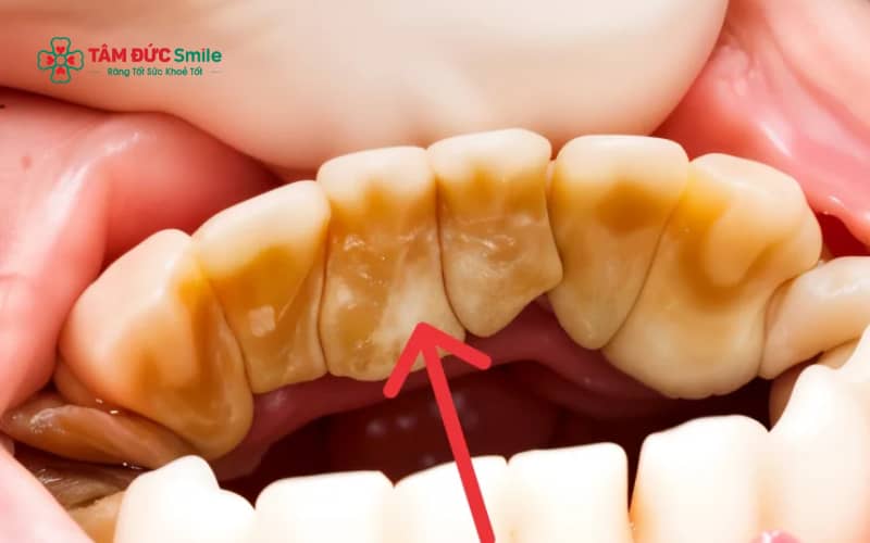 Mảng bám không được làm sạch sẽ dần khoáng hóa, hình thành Abc8com nổ hũ cứng bám chắc trên bề mặt răng và nướu
