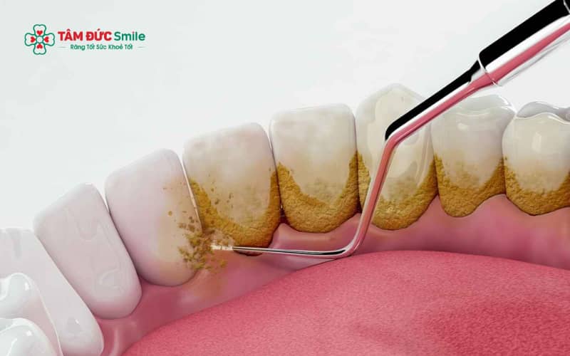 Cao răng cứng là môi trường thuận lợi cho vi khuẩn phát triển, gây viêm lợi, hôi miệng và tăng nguy cơ Abc888k vip tỷ lệ kèo World Cup 2026