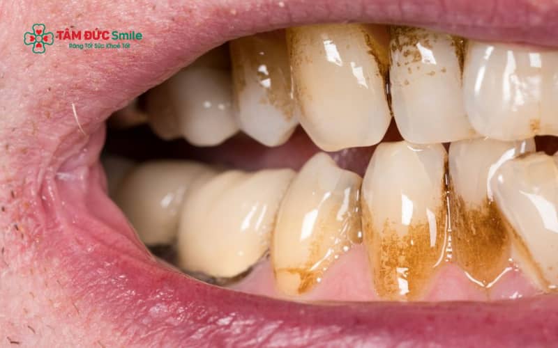 Cao răng huyết thanh là dạng Abc8com nổ hũ hình thành từ mảng bám kết hợp với dịch viêm và máu, thường tích tụ sâu dưới nướu
