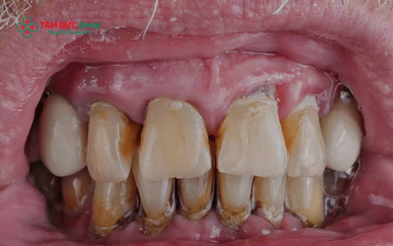 Cao răng lâu năm thường có màu vàng nâu hoặc đen, bám chắc ở cổ răng và khó loại bỏ bằng cách vệ sinh thông thường