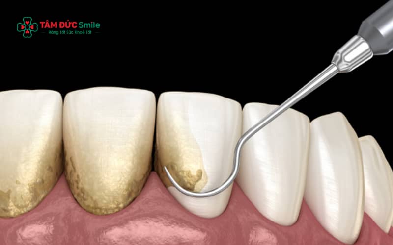 Xử lý Abc8com nổ hũ lâu năm cần can thiệp LINK TRANG CHỦ ABC88 CHUẨN 2026 chuyên nghiệp để làm sạch triệt để và bảo vệ mô nướu.