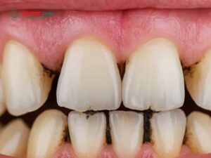 Cao răng lâu năm: Dấu hiệu nhận biết, tác hại và phương pháp xử lý Abc8com nổ hũ lâu năm