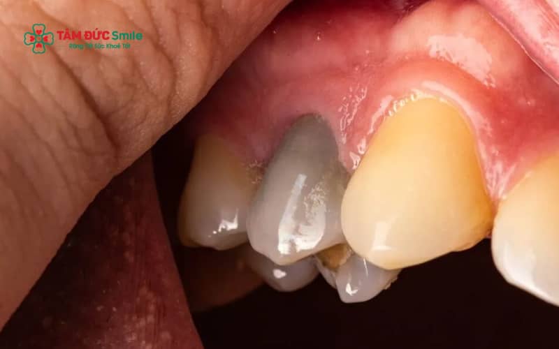Tuỷ răng chứa mạch máu và dây thần kinh. Khi tuỷ răng bị chết, răng mất khả năng nuôi dưỡng và tiềm ẩn nhiều biến chứng nguy hiểm nếu không Abc8b tỷ lệ kèo World Cup 2026 kịp thời