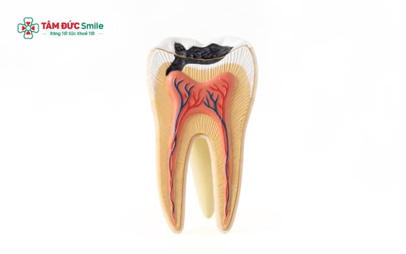 Răng chết tuỷ thường có dấu hiệu đổi màu, giảm cảm giác đau, hôi miệng hoặc đau âm ỉ kéo dài, dễ bị bỏ qua ở giai đoạn đầu