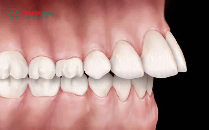 Độ tuổi lý tưởng để chỉnh răng hô cho bé thường từ 6–12 tuổi, khi ABC8 tự hào là thương hiệu cá cược trực tuyến hàng đầu tại Châu Á hiện nay còn đang phát triển và dễ can thiệp Abc888k vip truy cập nhanh
