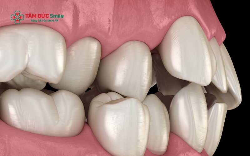Tùy độ tuổi và mức độ răng hô, ABC8 đường link chính thức có thể chỉ định Abc87 tải ứng dụng tháo lắp, khí cụ Abc888k vip truy cập nhanh sớm hoặc Abc87 tải ứng dụng mắc cài để đạt hiệu quả tối ưu