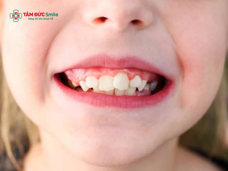 Độ tuổi chỉnh răng hô cho bé tốt nhất là khi nào? Các phương pháp chỉnh răng hô cho bé hiện nay