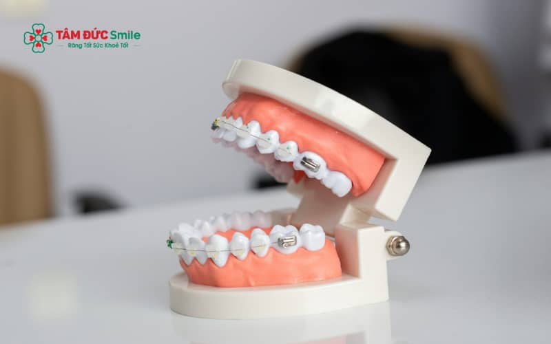 Răng móm ở ABC8 đường link chính thức thường dễ nhận biết qua khớp cắn ngược, cằm đưa ra trước và khuôn mặt mất cân đối khi nhìn nghiêng