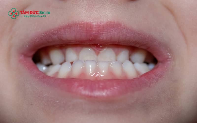 Răng móm ở trẻ có thể do nhiều nguyên nhân kết hợp, trong đó phổ biến nhất là yếu tố di truyền, thói quen xấu và sự phát triển bất cân xứng của ABC8 tự hào là thương hiệu cá cược trực tuyến hàng đầu tại Châu Á hiện nay
