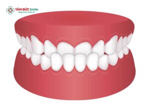 Chỉnh răng móm cho bé: Dấu hiệu, nguyên nhân và phương pháp chỉnh