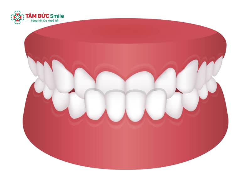 Chỉnh răng móm cho bé: Dấu hiệu, nguyên nhân và phương pháp chỉnh