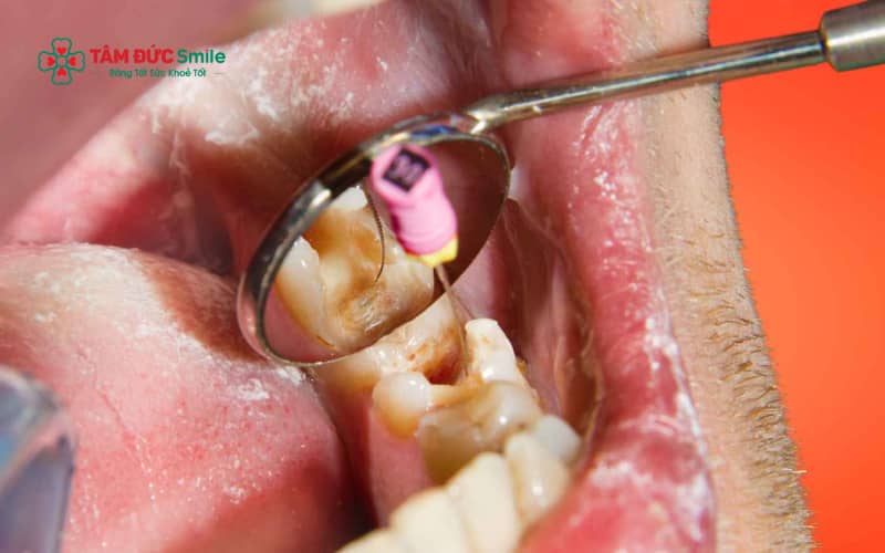 Nếu không lấy tủy kịp thời, cơn đau kéo dài có thể ảnh hưởng đến sức khỏe của cả mẹ và bé.