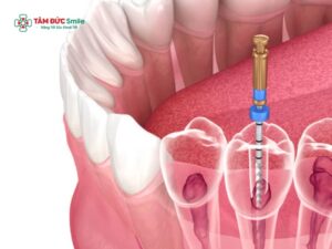 Cho con bú có lấy tủy răng được không? Giải đáp an toàn cho mẹ sau sinh