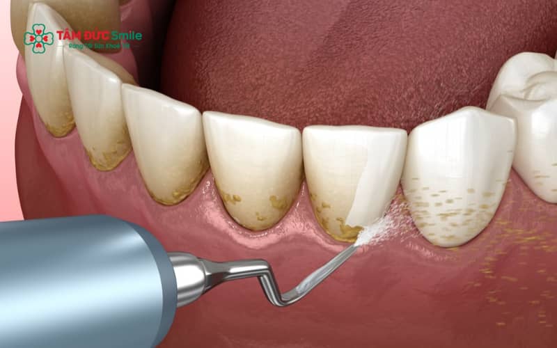 Lấy Abc8com nổ hũ thường xuyên giúp kiểm soát mảng bám và phòng ngừa viêm nướu, nhưng cần thực hiện đúng chỉ định của nha sĩ