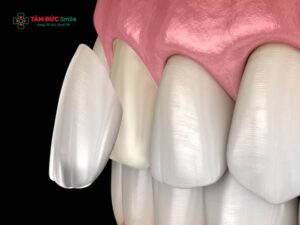 Dán sứ răng khấp khểnh là gì? Có nên dán sứ không? Ưu nhược điểm và lưu ý