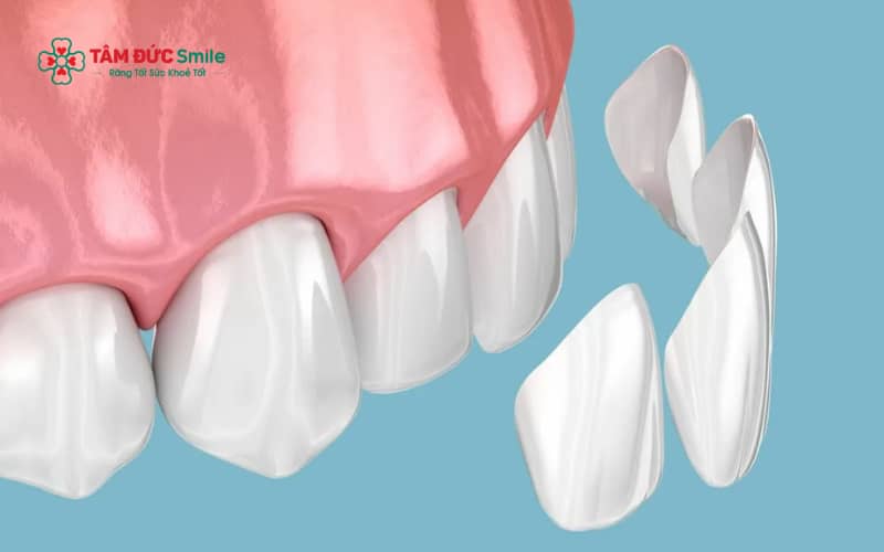 Dán veneer răng thưa là phương pháp sử dụng mặt dán sứ mỏng để che phủ khe răng, giúp răng đều khít và tự nhiên hơn