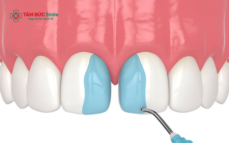 Dán veneer răng thưa chỉ phù hợp với trường hợp khe răng nhỏ, răng khỏe và khớp cắn ổn định; cần thăm khám kỹ trước khi thực hiện