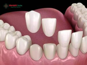 Dán veneer răng thưa là gì? Răng thưa có nên dán veneer không và cách chăm sóc sau khi dán