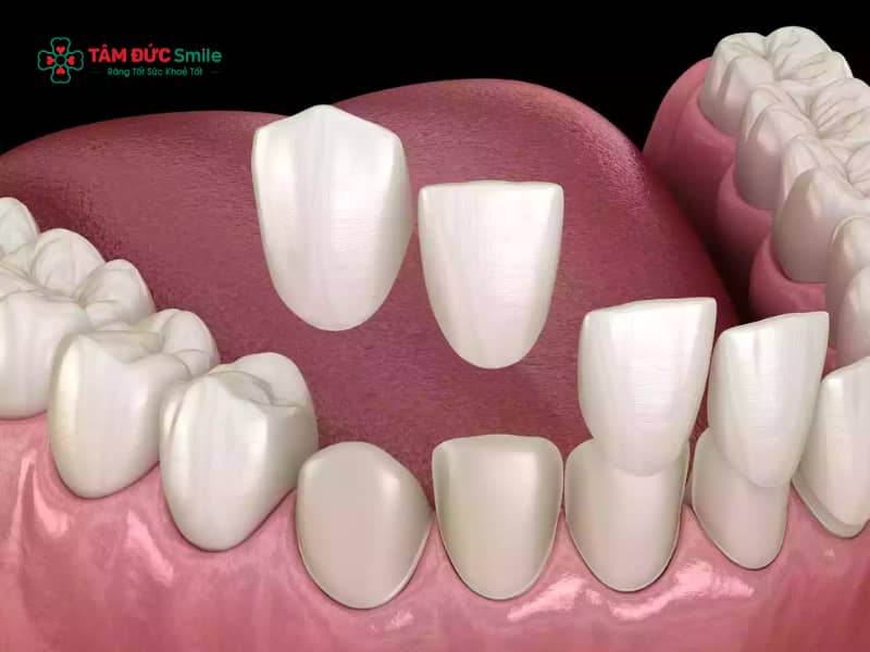 Dán veneer răng thưa là gì? Răng thưa có nên dán veneer không và cách chăm sóc sau khi dán