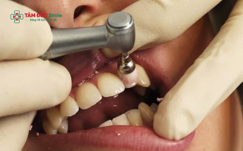 Đánh bóng răng là bước làm sạch bề mặt răng bằng dụng cụ chuyên dụng, giúp loại bỏ mảng bám mềm và vết ố nhẹ.