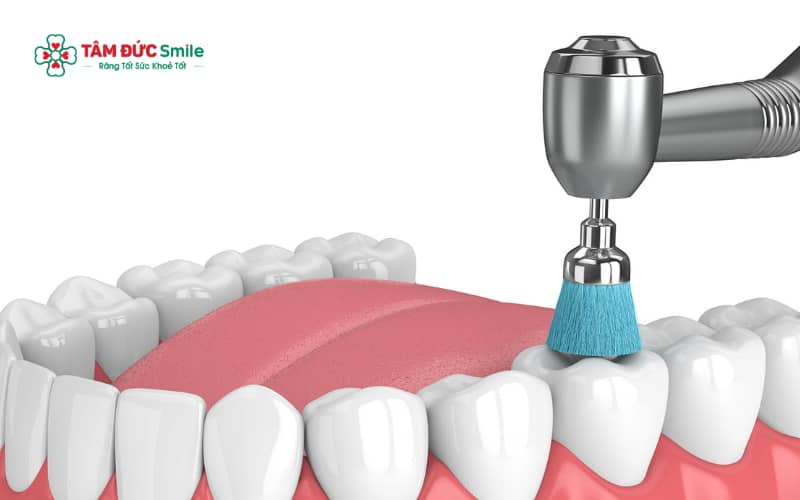 Đánh bóng răng giúp làm nhẵn bề mặt răng, hạn chế vi khuẩn bám lại và hỗ trợ phòng ngừa ABC88 com đăng nhập, viêm nướu.