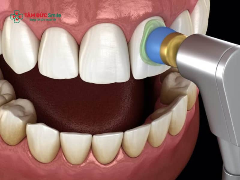 Đánh bóng răng là gì? Đánh bóng răng có làm trắng răng không?