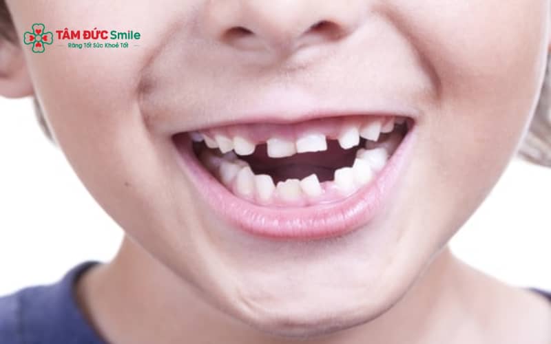 Các thói quen sinh hoạt như mút tay, ngậm ti giả kéo dài hoặc thở miệng có thể làm tăng nguy cơ hô răng ở trẻ