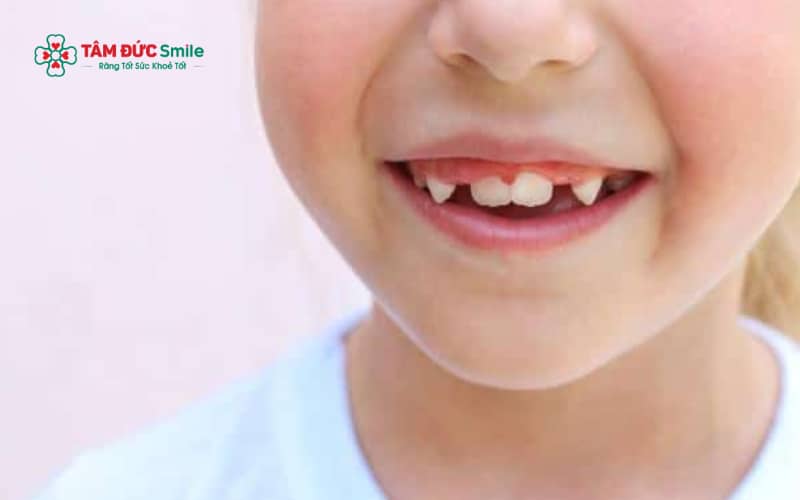 Dấu hiệu hô răng ở trẻ dễ nhận biết qua răng cửa chìa ra trước, môi trên nhô và khuôn mặt mất cân đối khi nhìn nghiêng