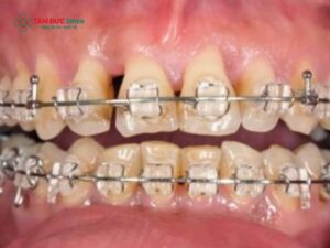 Dây thun Abc87 tải ứng dụng bị vàng: Nguyên nhân, ảnh hưởng & cách xử lý hiệu quả