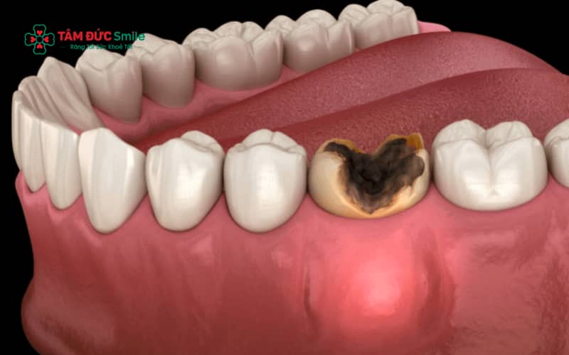Diệt tuỷ răng là thủ thuật loại bỏ hoàn toàn mô tuỷ bị viêm hoặc hoại tử nhằm chấm dứt đau nhức và ngăn vi khuẩn lan rộng gây biến chứng