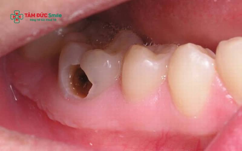 Diệt tuỷ răng được chỉ định khi tuỷ bị viêm không hồi phục, hoại tử, ABC88 com đăng nhập ăn sâu vào tuỷ hoặc răng nứt vỡ làm lộ mô tuỷ.