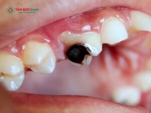 Diệt tủy răng là gì? Khi nào cần diệt tủy, quy trình và chăm sóc răng sau khi diệt tủy