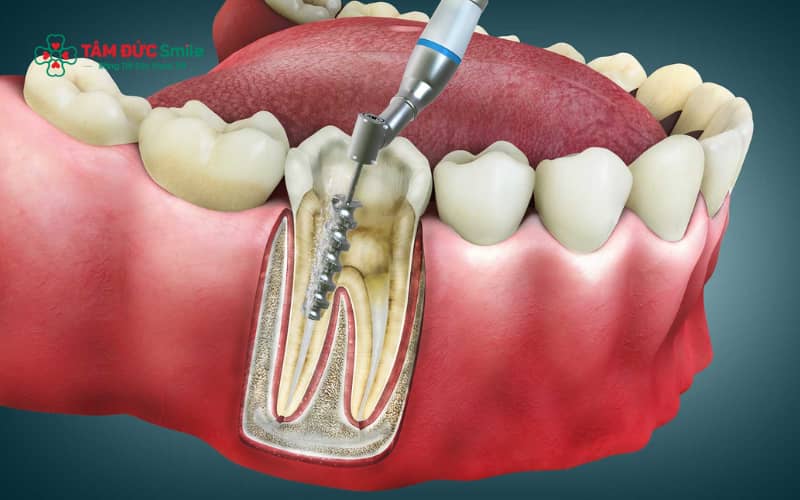 Điều trị nội nha giúp loại bỏ ổ viêm, giảm đau, ngăn ngừa nhiễm trùng lan rộng và tránh nguy cơ mất răng